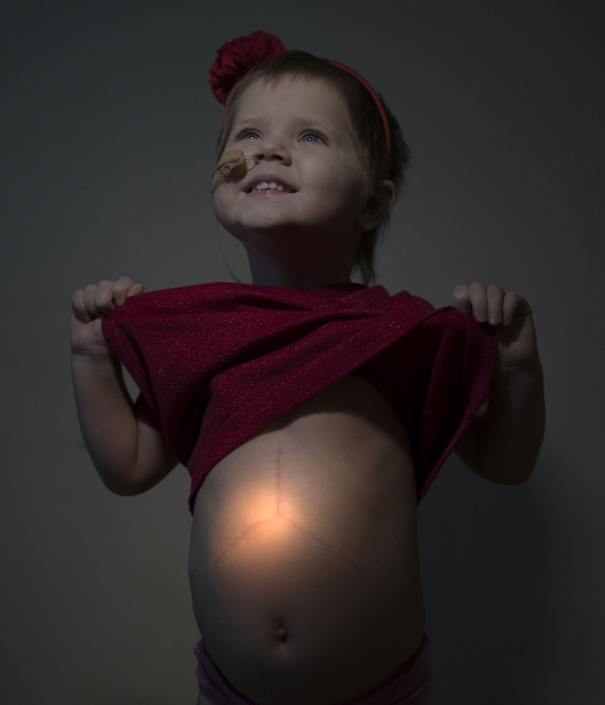 Bildreportage om barncancer.
Alice Wennberg Thelin, 3år. Levertumör. Behandlas för cancer i levern och har fått en bit av sin farmors lever.