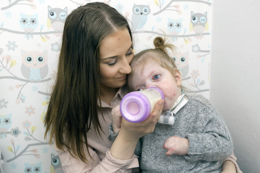meja fddes med aperts syndrom. hanna heimersson tillsammans med dotter meja som fddes med aperts syndrom, ett medftt kraniofacial missbildningssyndrom,